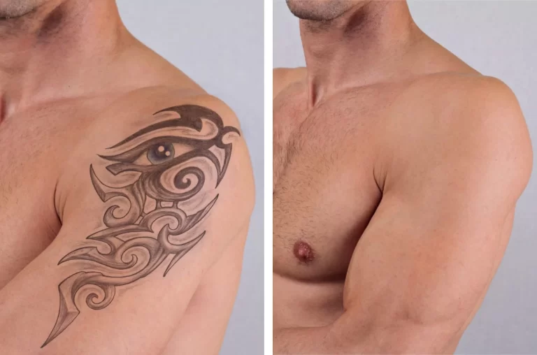 Quitar tatuajes antes y después