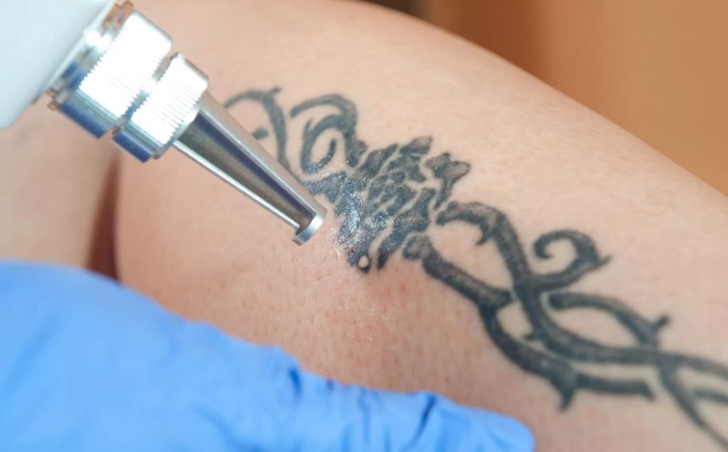 clínica de eliminación de tatuajes en Badajoz