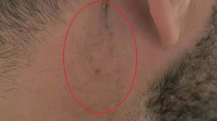 eliminación micropigmentación cejas