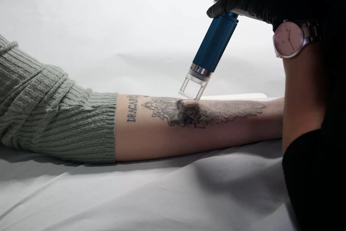 Eliminar tatuajes en Torrejón de Ardoz